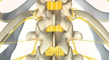 Clinical Update: Cauda equina syndrome